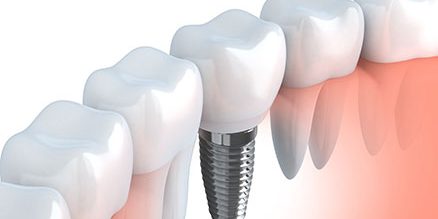 implant