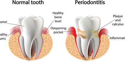 normal-vs-periodontitis